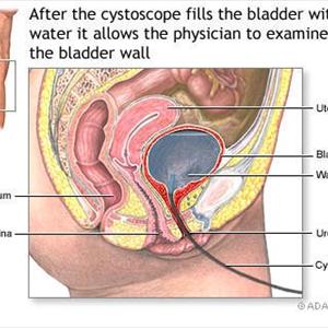 Definition Of Urinary Bladder Inflammation 