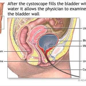 Definition Of Urinary Bladder Inflammation - Why Drinking Water Helps Prevent Urinary Tract Infections