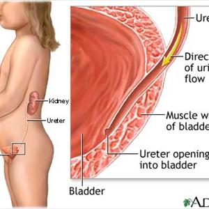 Causes Of Uti Infections - Have You Tried An Acidic Diet For The Natural Treatment Of Your Urinary Tract Infection