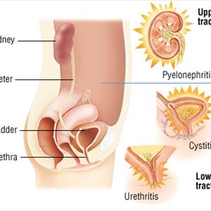  Urethritis 