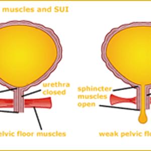 Foul Smelling Urine Community - Bladder Infection Symptoms