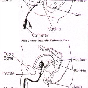 Dosage Of Cipro For Uti - Precautions To Avoid Bladder Infections Among Girls