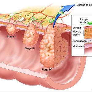 Uti And Cranberry Juice - It Can Happen To Anyone - Urinary Tract Infection