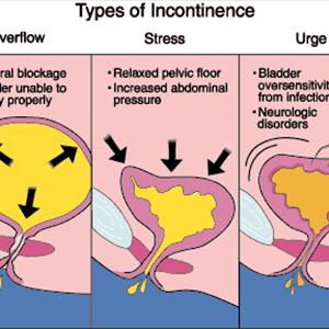  Urinary Infection Home Treatment 