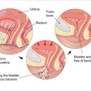 Cranberry Juice And Uti - It Can Happen To Anyone - Urinary Tract Infection